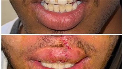 إجراء أول عملية تجميل شفط دهون ونحت قوام فى مستشفى سوهاج