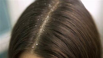 وصفة طبيعية وسريعة المفعول تخلصك من قشرة الشعر 