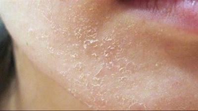 قناع طبيعي يخلصك من قشور البشرة فى الشتاء 