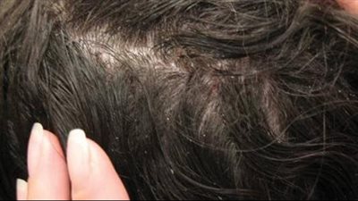 علاج قمل الشعر، العدوى الأكثر انتشارا في المدارس