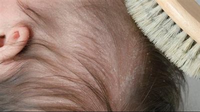 الطريقة الصحيحة للتعامل مع قشرة الشعر عند الأطفال حديثي الولادة 