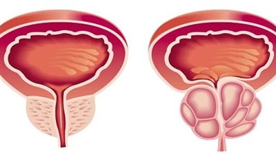 ابتكار دواء جديد لعلاج التهاب المثانة في روسيا