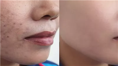 قناع طبيعي يخلصك من كلف الحمل بالبشرة بعد الولادة 