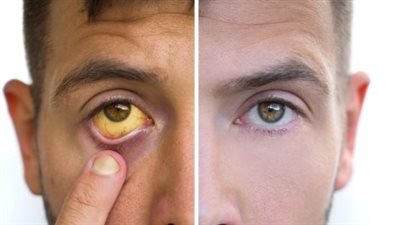  الصفراء لدى البالغين، الأسباب والأعراض والعلاج