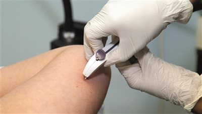  مزايا استخدام كبسولة تحت الجلد لمنع الحمل وما هي أعراضها الجانبية؟