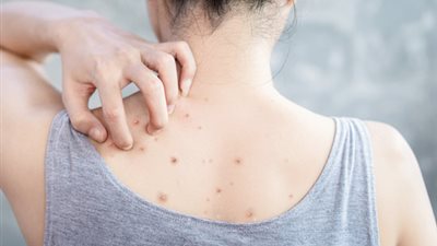3 طرق بسيطة للتخلص من علامات وندبات حب الشباب بالظهر