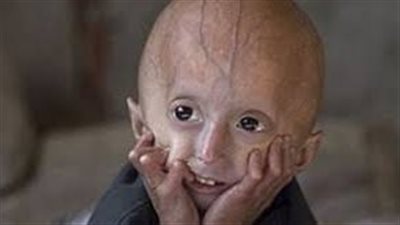 متلازمة الشيخوخة المبكرة، عندما يسرق الزمن طفولتك