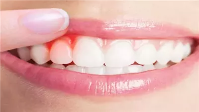 أسباب نزيف اللثة، منها الهرمونات والالتهابات