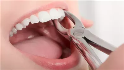 تفسير حلم خلع الضرس في المنام وعلاقته بالحصول على ثروة مالية 