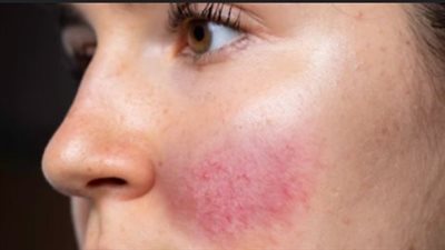 أعراض وأسباب الإصابة بالوردية، وطرق الوقاية من المضاعفات