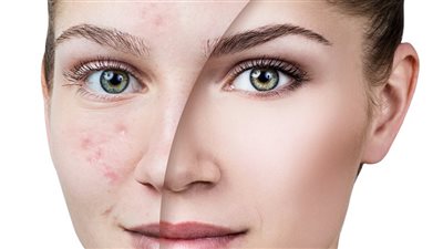 الحماية من حب الشباب باستخدام الزيوت الأساسية