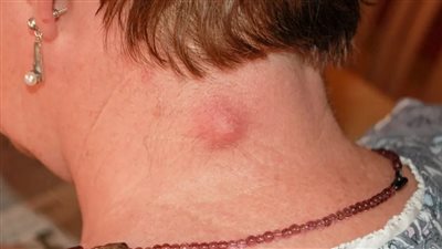  أسباب ظهور الكتل الصلبة تحت الجلد، ومتي تكون مؤشرا على السرطان؟