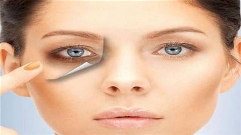 الهالات السوداء وعلاجها