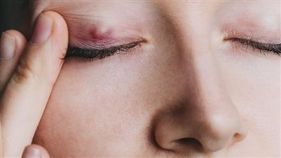 أسباب ظهور بثور على جفن العين وطرق علاجها بالمنزل
