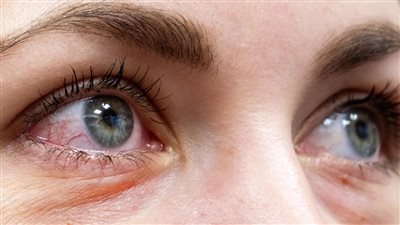أسباب إحمرار العين، ومتى تدل على حالة طبية طارئة؟