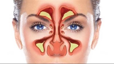  أعراض الجيوب الأنفية الحادة.. وطرق علاجها من البيت