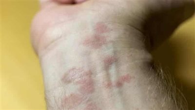 طرق التخلص من حساسية الجلد والهرش