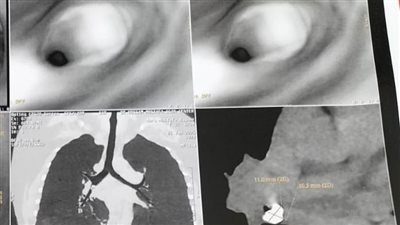 نجاح استخراج جسم غريب لمريضة دون استئصال الرئة بمستشفى قلب اسيوط