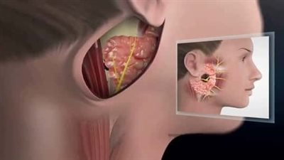 أعراض وأسباب التهاب الغدة النكافية، ومتى تكون معدية؟