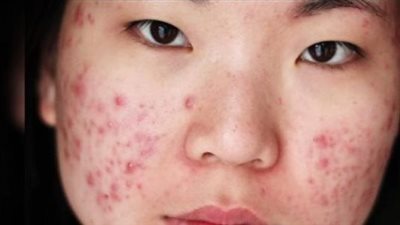 كيف تؤدي متلازمة تكيس المبايض لظهور حب الشباب، وما هي طرق العلاج المختلفة؟