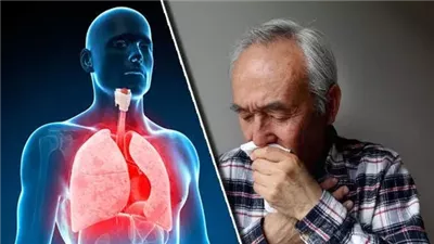 أعراض التهاب الشعب الهوائية وطرق علاجها بالمنزل