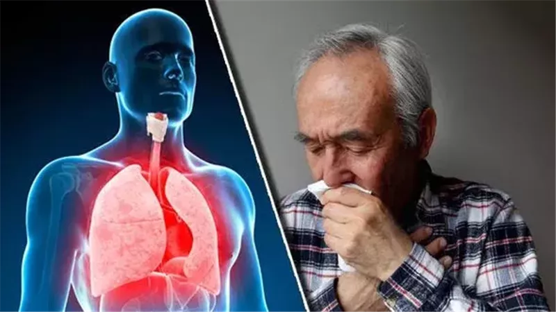 علاج التهاب الشعب
