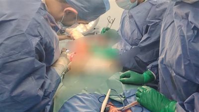 استئصال جزء من الأمعاء لمُسنة، وإزالة أكياس شيكولاتة على المبيض، نجاحات جديدة للفرق الطبية بوزارة الصحة