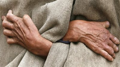 الصحة تكشف طرق العدوى بمرض الجذام وتوفر علاجه مجانا بكل المحافظات