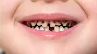 تفسير حلم تسوس الأسنان في المنام وعلاقته بحل جميع المشاكل 