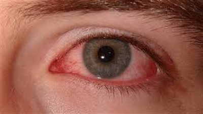 قد يؤدي إلى اعتام العدسة، تأثير التهاب المفاصل الصدفي على العين