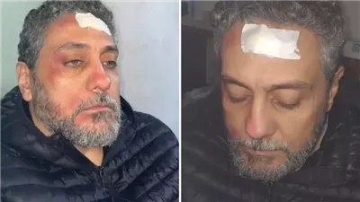 إصابة تامر فرج خلال تصوير مسلسل وش السعد (صور)