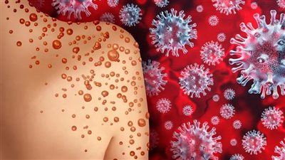 نيويورك تسجل أول حالة إصابة بسلالة جدري القردة الجديدة 