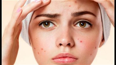 ماسكات طبيعية للتخلص من حبوب الوجه