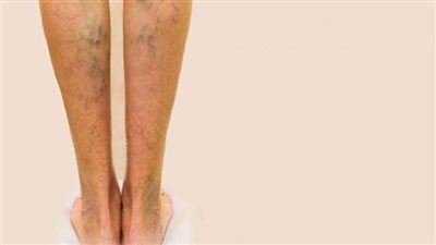 أهمها جوارب الضغط، طرق بسيطة لعلاج الدوالي في المنزل