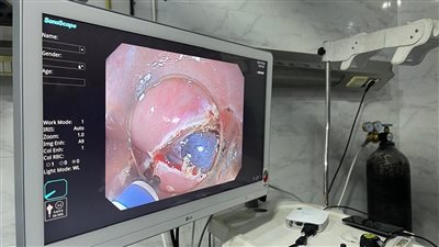 مستشفى منيا القمح المركزي ينجح في إجراء تدخلات متطورة بتقنية الفراغ الثالث