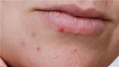 كيفية التخلص من البثور حول الشفتين بالمنزل