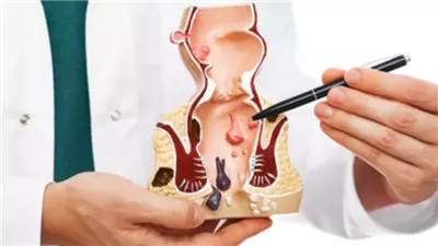 أعراض الإصابة بالشرخ الشرجي، وطرق علاجه بالمنزل