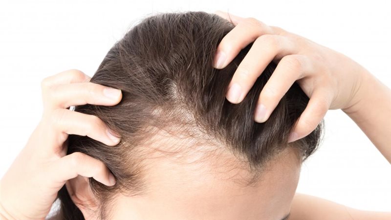 علاج تساقط الشعر،