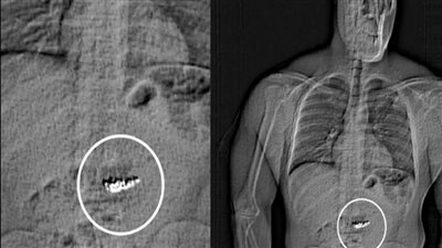 أغرب حادث سرقة، لص يبلتع مجوهرات بقيمة 770 ألف دولار