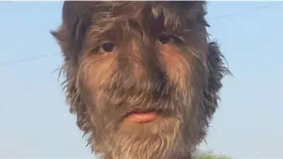 هندي يدخل موسوعة جينيس بسبب شعر وجهه