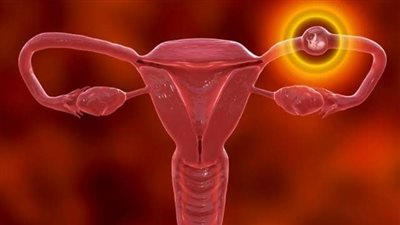 أبرزها التدخين، أهم أسباب الحمل خارج الرحم..هل يمكن علاجه؟ 