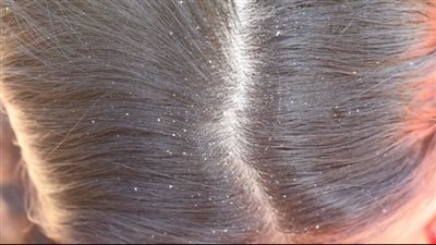 وصفات طبيعية تخلصك من قشرة الشعر 