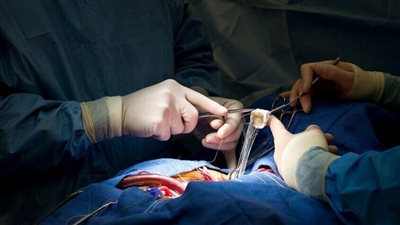 الصين تنجح في زرع كلية خنزير معدلة وراثيًّا في إنسان