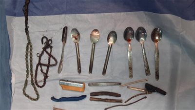 إنجاز طبي بسوهاج الجامعي، فريق جراحي ينقذ حياة مريض ابتلع مقصات ومعالق