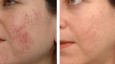 قناع طبيعي يخلصك من آثار حب الشباب بالبشرة 