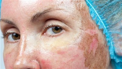 فوائد وأضرار التقشير الكيميائي للبشرة 