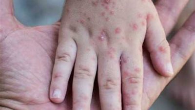 انتشار الجدري المائي بين الأطفال يثير المخاوف.. الأطباء: تناول الأسبرين يسبب الوفاة.. المضادات الحيوية ممنوعة.. الحقن الخطأ تسبب الفشل الكلوي.. والعزل والتطعيم هما الحل 