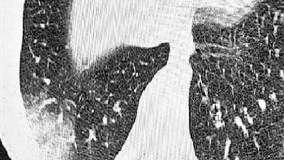 اكتشاف أول إصابة بمرض 