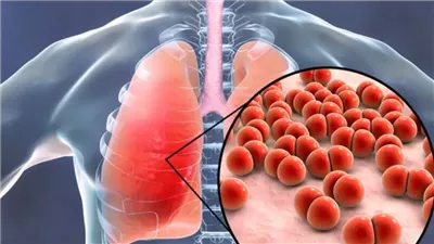 في اليوم العالمي للسل.. الصحة العالمية: يصيب شخصا كل 34 ثانية.. وفاة مريض كل 6 دقائق.. ولدينا 3 من كل 10 مصابين لا يتلقون العلاج