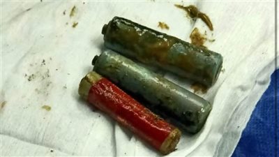 استخراج 3 أحجار ريموت من معدة مريض بمعهد الكبد فى المنوفية